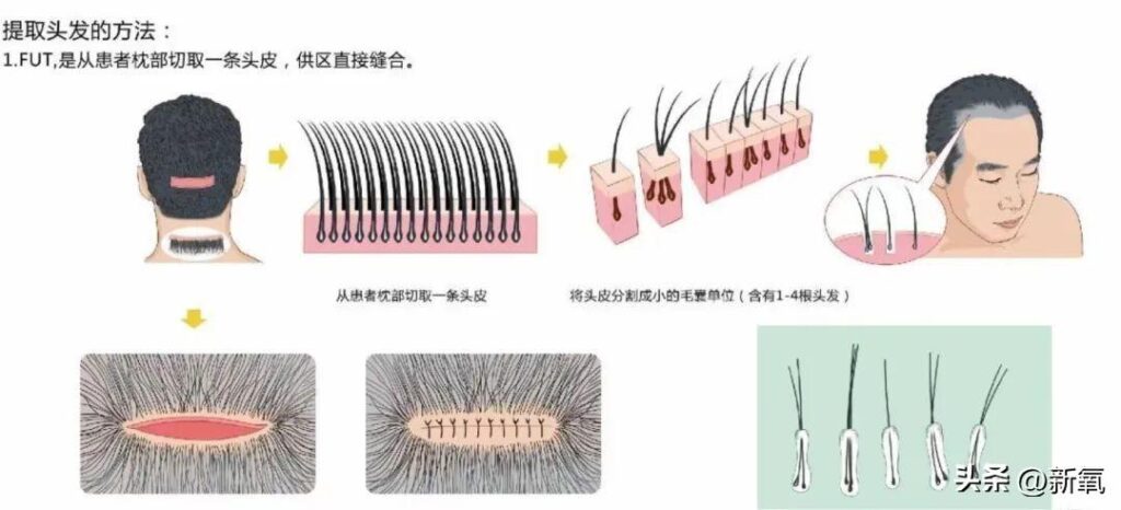 哪里种头发比较好_c罗在马德里开的植发店在哪里