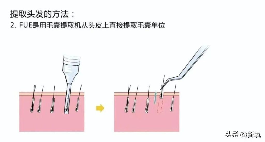 哪里种头发比较好_c罗在马德里开的植发店在哪里