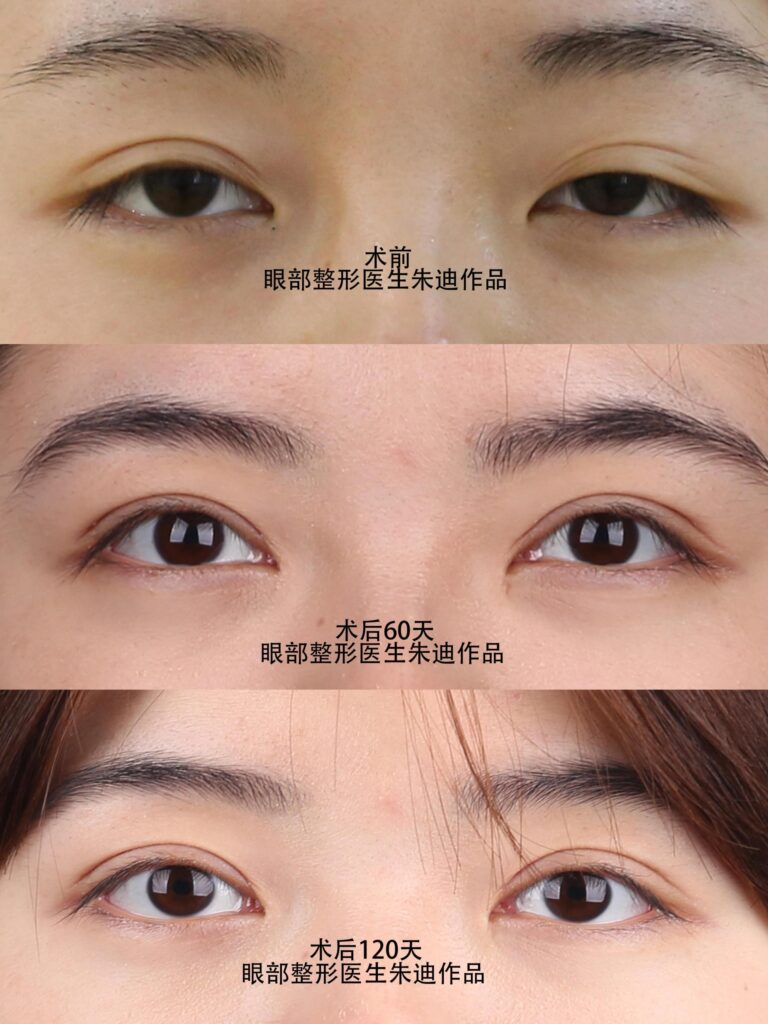 做个双眼皮多少钱_双眼皮失败案例
