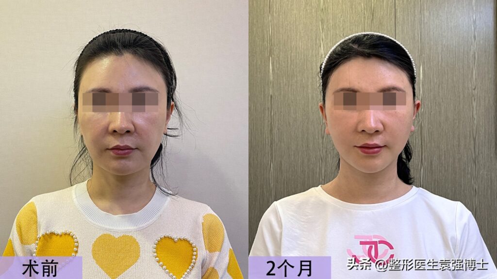 面部提拉术需要多少钱，费用受哪些条件影响