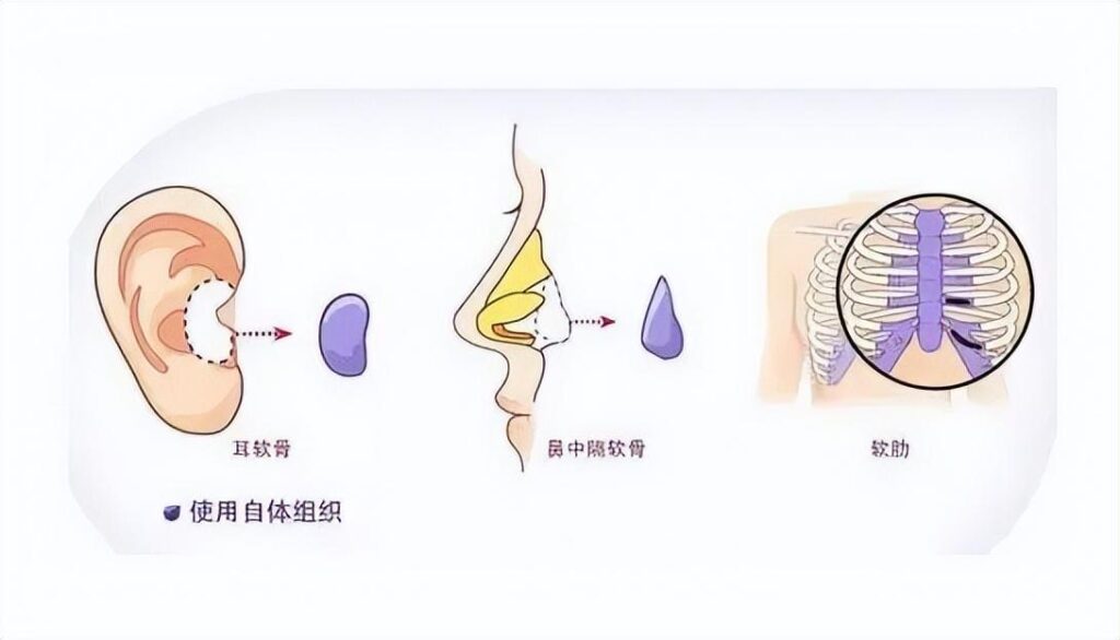 上海垫鼻子医院 ，三种不同的隆鼻方式