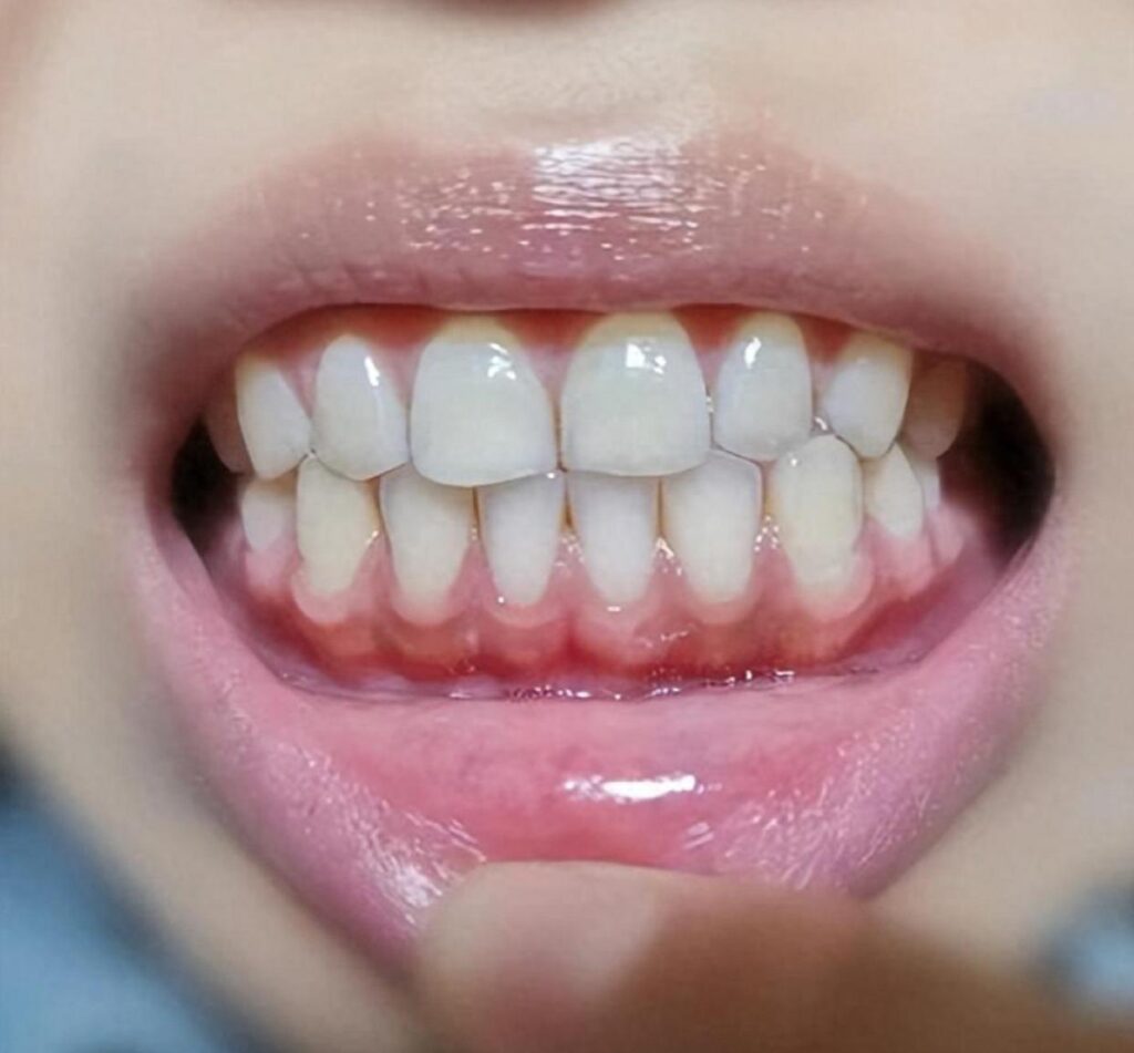 牙齿很黄可以洗白吗？网友推荐的三步刷牙法？