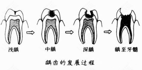 去医院补牙要多少钱？牙齿损坏情况以及选择的材料价格