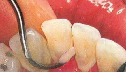 牙结石图片及形成原因，牙结石清理前后对比