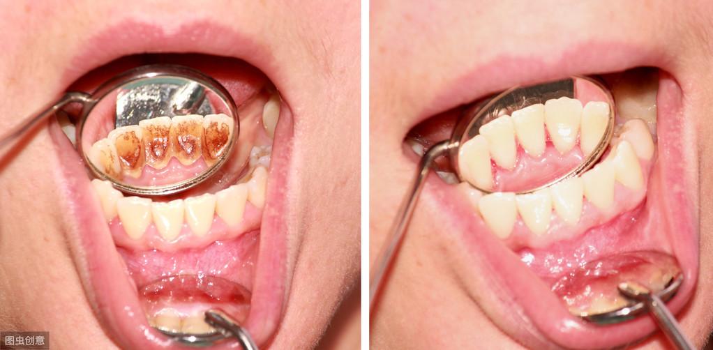 牙结石图片及形成原因，牙结石清理前后对比