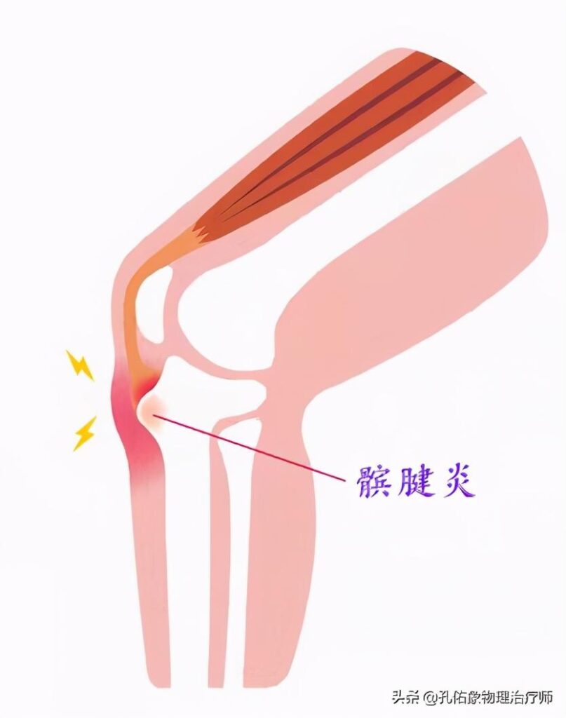 膝关节疼痛什么原因？膝前疼痛是怎么回事？
