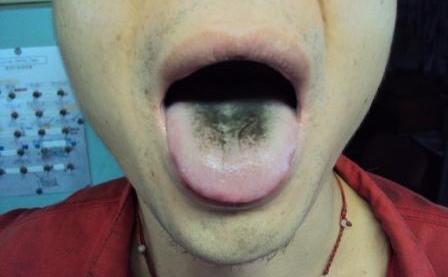 舌头发黑是什么原因？舌苔发黑是怎么回事？
