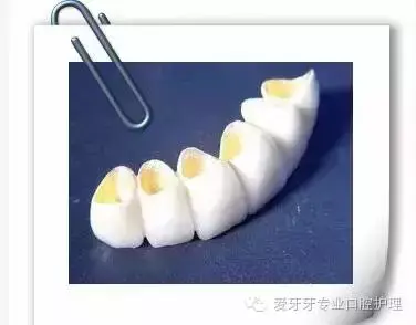钛合金牙套一般是多少钱？哪些病症需要使用烤瓷牙？