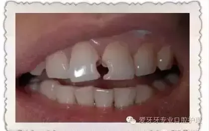 钛合金牙套一般是多少钱？哪些病症需要使用烤瓷牙？