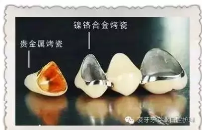 钛合金牙套一般是多少钱？哪些病症需要使用烤瓷牙？
