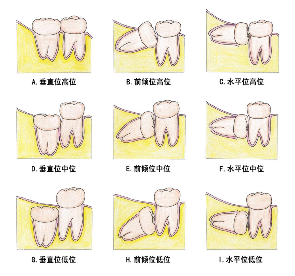 拔牙一般多少钱一颗？拔智齿要多少钱？
