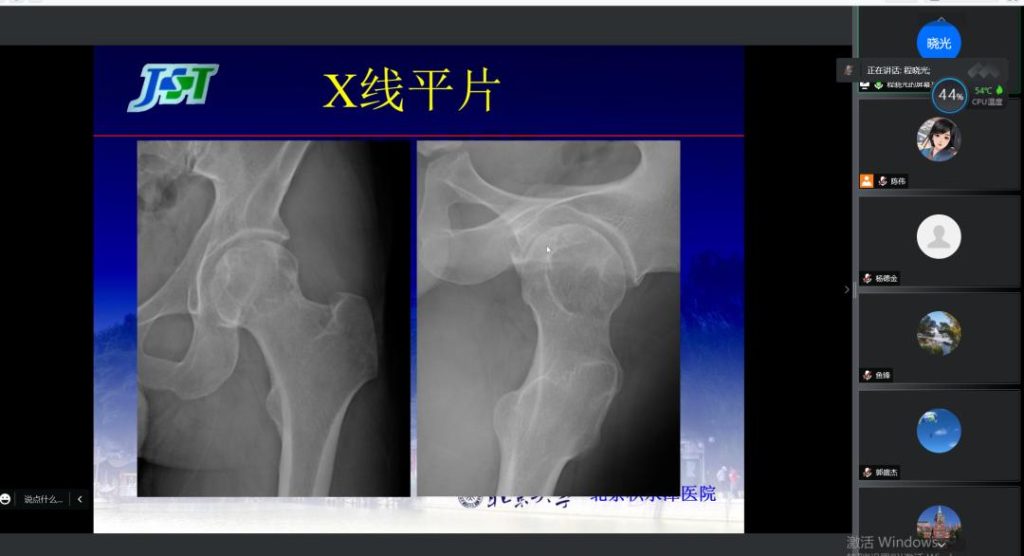 治疗股骨头北京哪家医院最好？骨坏死是什么疾病？